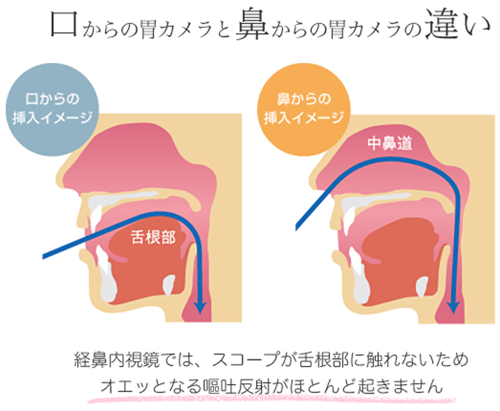 経鼻内視鏡検査 | 東近江市で内科・小児科をお探しの方は松尾医院へ